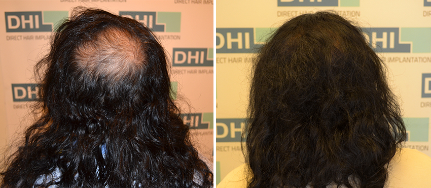 DHI before & after hair transplant results